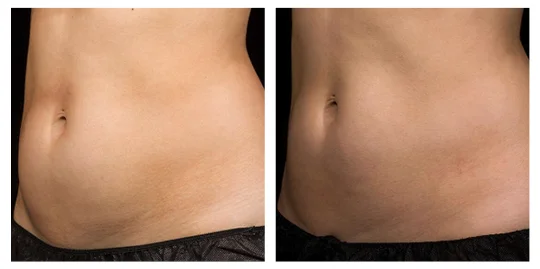 Kryolipolýza pred a po - brucho